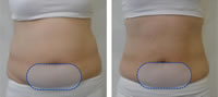Tratamiento en abdomen con COOLshaping