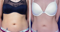 Tratamiento en abdomen con CoreSculpt