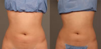 Tratamiento en abdomen con LIPOcel