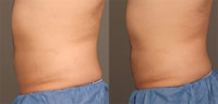 Tratamiento en abdomen con LIPOcel