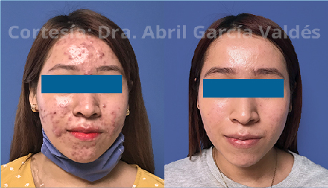 Tratamiento de Acné con Plapen dual