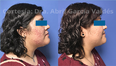 Tratamiento de Acné con Plapen dual