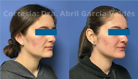 Tratamiento de Acné con Plapen dual