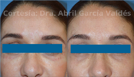 Tratamiento de Contorno de ojos con Plapen dual