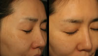 Tratamiento de melasma con TRI-BEAM Premium