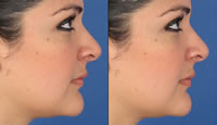 Tratamiento de melasma en mejillas con TRI-BEAM Premium
