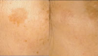 Tratamiento de melasma con TRI-BEAM Premium
