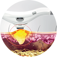Tratamiento de Acné con Cellec V