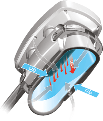 Pieza de mano del equipo COOLshaping