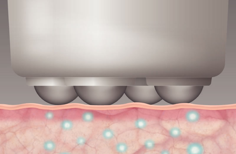 Electroporación por Radiofrecuencia