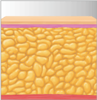 Afectación de células grasas con LIpo1060