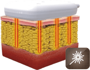 Láses de bajo nivel de Noble SHAPE