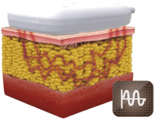 Frecuencia Media de Amplitud Modulada de Frecuencia Media de Noble SHAPE