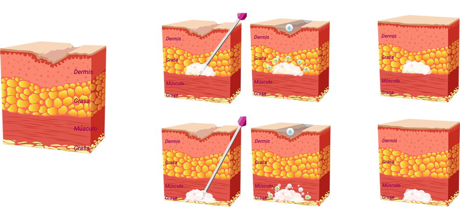 Regeneración de colágeno con olidia