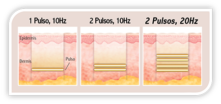 Gráfica de Tonificación Rich-PTP de TRI-BEAM Premium