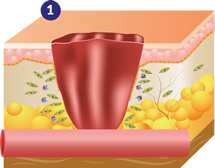 Fase de inflamación con ULTRAcel Q+