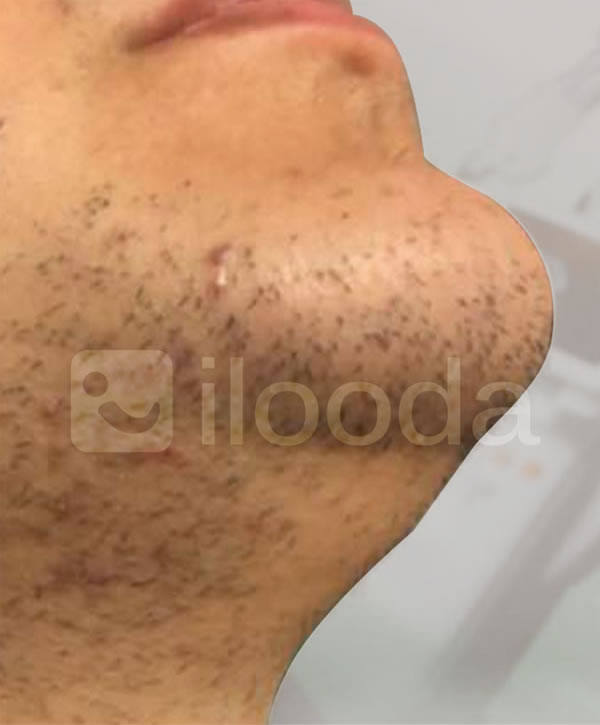 Imagen de antes del tratamiento con VeLux 