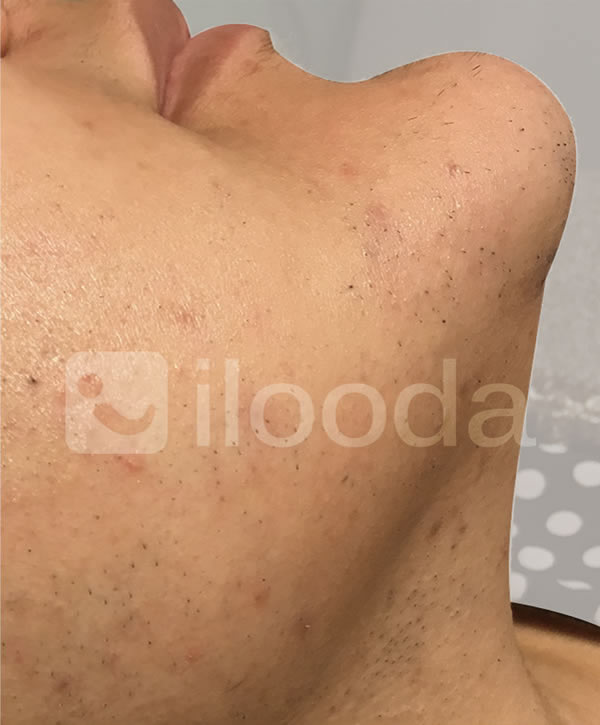 Imagen después de una sesión con VeLux