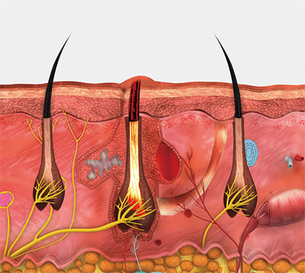 Zona tratada con VeLux